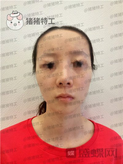 南京美贝尔黄名斗面部填充案例价格分享,填完整个皮肤光泽度惊人~