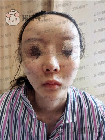 南京美贝尔黄名斗面部填充案例价格分享,填完整个皮肤光泽度惊人~