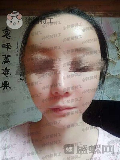 南京美贝尔黄名斗面部填充案例价格分享,填完整个皮肤光泽度惊人~