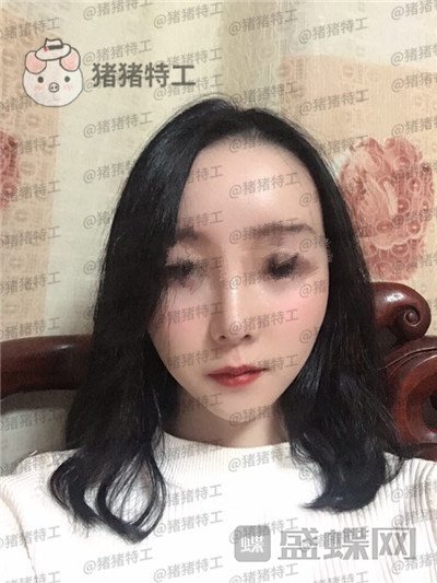 南京美贝尔黄名斗面部填充案例价格分享,填完整个皮肤光泽度惊人~