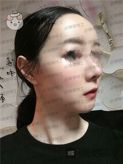 南京美贝尔黄名斗面部填充案例价格分享,填完整个皮肤光泽度惊人~