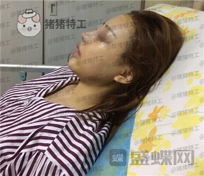 邯郸雅丽刘雅丽隆鼻案例价格分享,做完秒变小仙女好看的鼻子装嫩神器~
