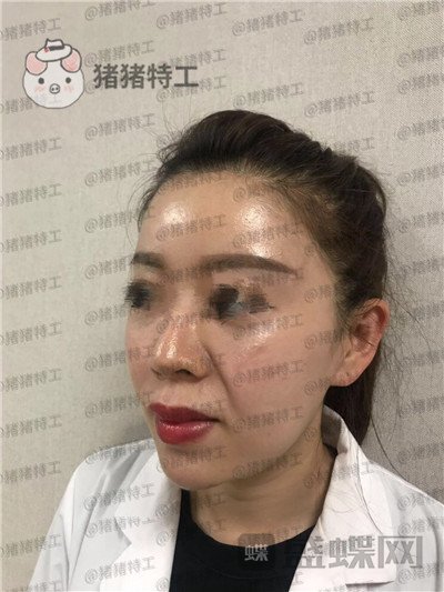 北京炫美徐学东垫鼻基底案例价格分享,老阿姨变身高中生果有点神奇~