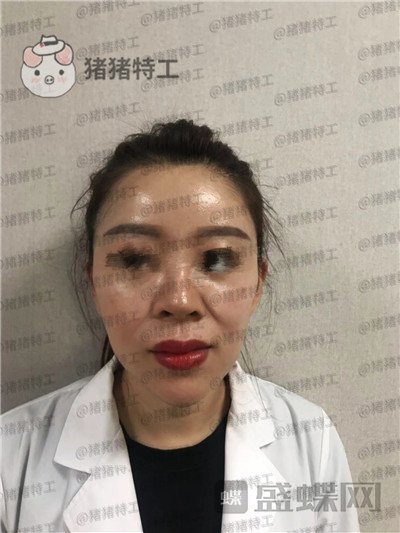 北京炫美徐学东垫鼻基底案例价格分享,老阿姨变身高中生果有点神奇~