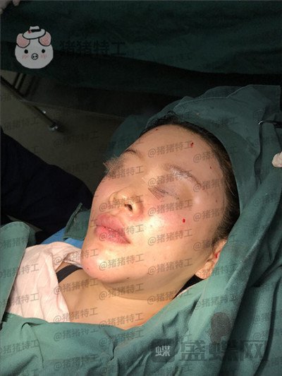 北京炫美徐学东垫鼻基底案例价格分享,老阿姨变身高中生果有点神奇~