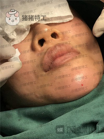 北京炫美徐学东垫鼻基底案例价格分享,老阿姨变身高中生果有点神奇~