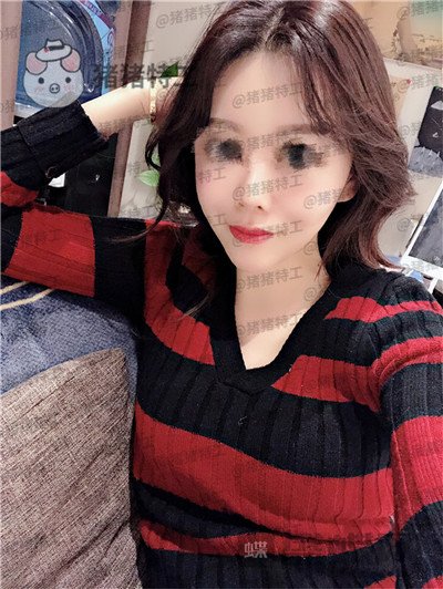 北京炫美徐学东垫鼻基底案例价格分享,老阿姨变身高中生果有点神奇~