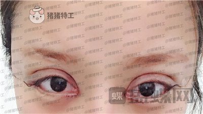 沈阳和平美联致美管连斌双眼皮案例价格分享,做完优惠力度大混血的双眼皮了解一下~