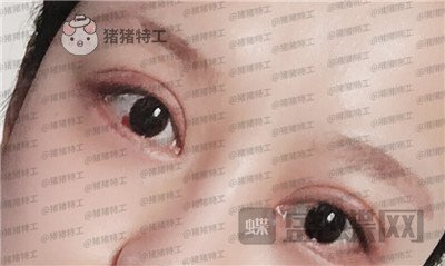 沈阳和平美联致美管连斌双眼皮案例价格分享,做完优惠力度大混血的双眼皮了解一下~