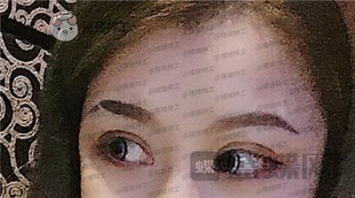 沈阳和平美联致美管连斌双眼皮案例价格分享,做完优惠力度大混血的双眼皮了解一下~