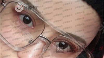 沈阳和平美联致美管连斌双眼皮案例价格分享,做完优惠力度大混血的双眼皮了解一下~