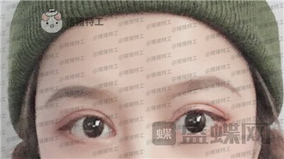 沈阳和平美联致美管连斌双眼皮案例价格分享,做完优惠力度大混血的双眼皮了解一下~