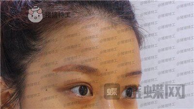 沈阳和平美联致美管连斌双眼皮案例价格分享,做完优惠力度大混血的双眼皮了解一下~