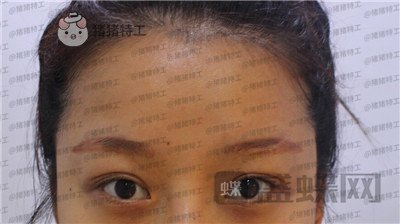 沈阳和平美联致美管连斌双眼皮案例价格分享,做完优惠力度大混血的双眼皮了解一下~