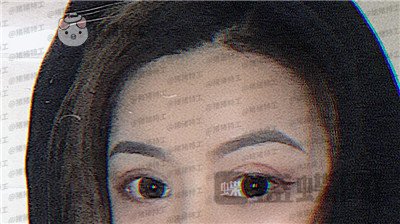 沈阳和平美联致美管连斌双眼皮案例价格分享,做完优惠力度大混血的双眼皮了解一下~