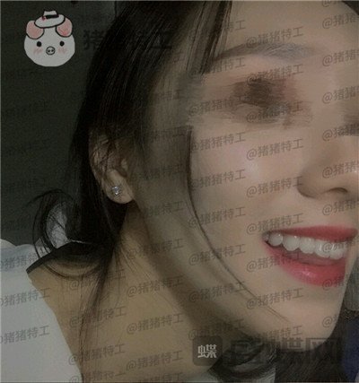 成都博爱李竞男牙齿美白案例价格分享,黄牙妹做完张口大笑再也不自卑~