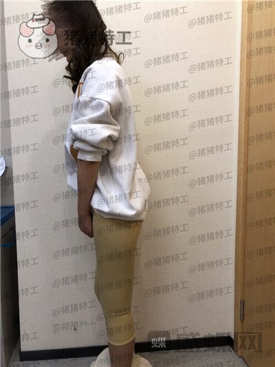 重庆瑞俪胡小义吸脂案例价格分享,又是一起腿玩年系列细长筷子腿get~