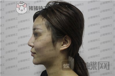 成都西区医院肖凌鼻修复案例价格分享,宝藏女孩做完很御姐范~
