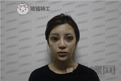 成都西区医院肖凌鼻修复案例价格分享,宝藏女孩做完很御姐范~