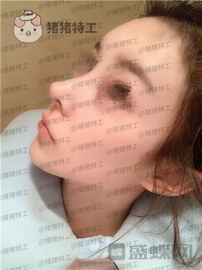 成都西区医院肖凌鼻修复案例价格分享,宝藏女孩做完很御姐范~