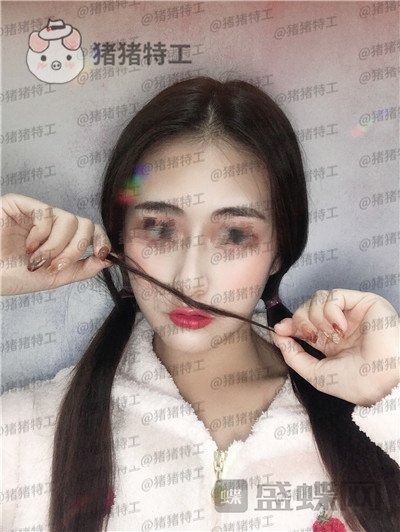 南京美贝尔黄名斗面部填充案例价格分享,黄面小姐姐做完整张脸发光的既视感~