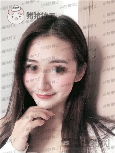 南京美贝尔黄名斗面部填充案例价格分享,黄面小姐姐做完整张脸发光的既视感~