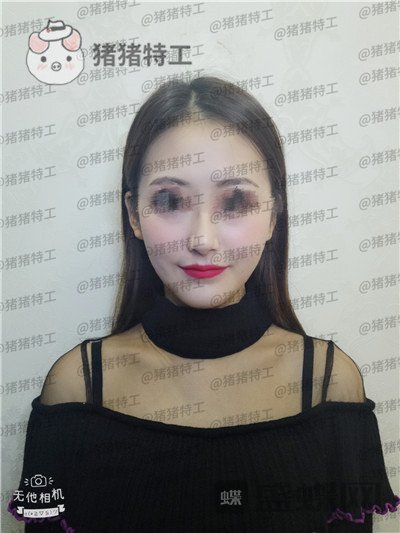 南京美贝尔黄名斗面部填充案例价格分享,黄面小姐姐做完整张脸发光的既视感~