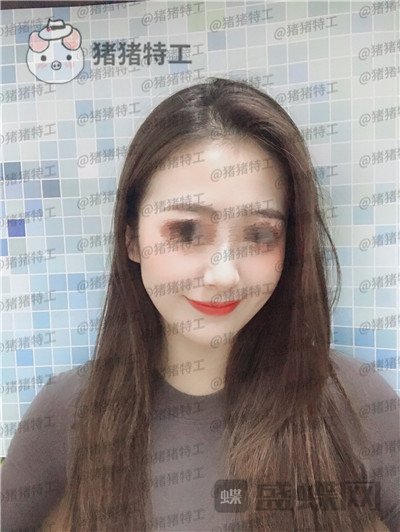 南京美贝尔黄名斗面部填充案例价格分享,黄面小姐姐做完整张脸发光的既视感~