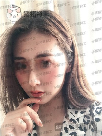 南京美贝尔黄名斗面部填充案例价格分享,黄面小姐姐做完整张脸发光的既视感~