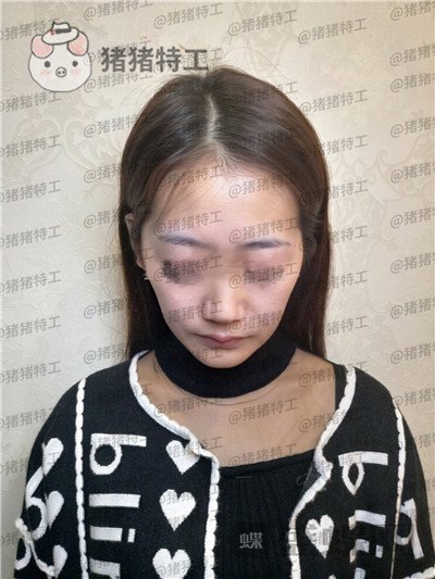 南京美贝尔黄名斗面部填充案例价格分享,黄面小姐姐做完整张脸发光的既视感~