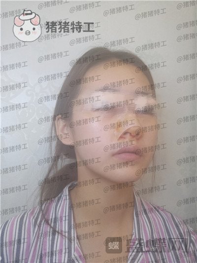 南京美贝尔黄名斗面部填充案例价格分享,黄面小姐姐做完整张脸发光的既视感~
