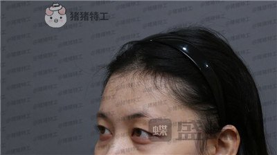 武汉美基元双眼皮案例价格分享,自卑的我终于有了闪闪有神的大眼睛~