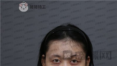武汉美基元双眼皮案例价格分享,自卑的我终于有了闪闪有神的大眼睛~