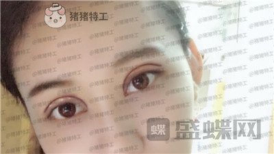 武汉美基元双眼皮案例价格分享,自卑的我终于有了闪闪有神的大眼睛~