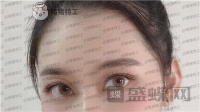 武汉美基元双眼皮案例价格分享,自卑的我终于有了闪闪有神的大眼睛~