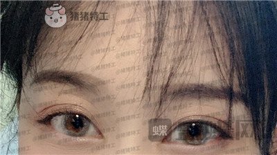 武汉美基元双眼皮案例价格分享,自卑的我终于有了闪闪有神的大眼睛~