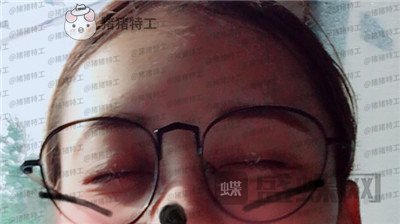 武汉美基元双眼皮案例价格分享,自卑的我终于有了闪闪有神的大眼睛~