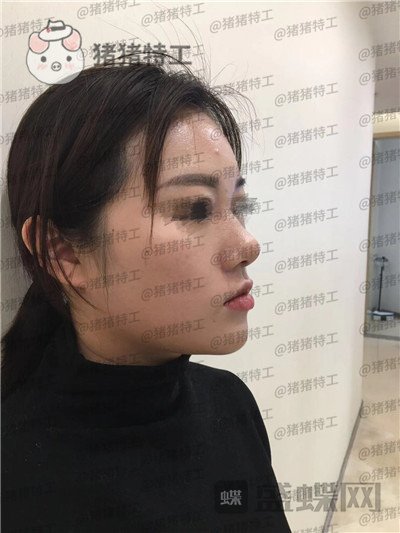 南京华韩奇致裴柄万隆鼻案例价格分享,这家的服务和成果太让我惊讶了~