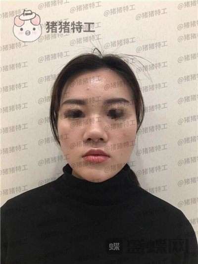 南京华韩奇致裴柄万隆鼻案例价格分享,这家的服务和成果太让我惊讶了~