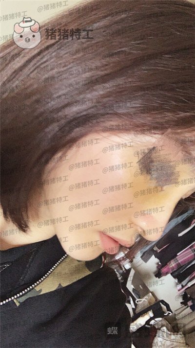 洛阳华美宋俊岭隆鼻案例价格分享,硅胶隆鼻好不好看了就知道!