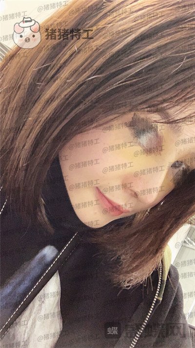 洛阳华美宋俊岭隆鼻案例价格分享,硅胶隆鼻好不好看了就知道!