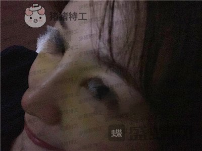 洛阳华美宋俊岭隆鼻案例价格分享,硅胶隆鼻好不好看了就知道!