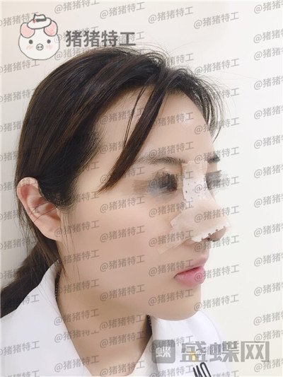 洛阳华美宋俊岭隆鼻案例价格分享,硅胶隆鼻好不好看了就知道!