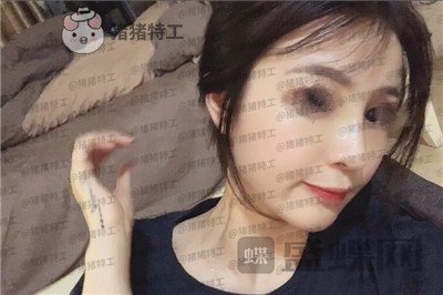 洛阳华美宋俊岭隆鼻案例价格分享,硅胶隆鼻好不好看了就知道!