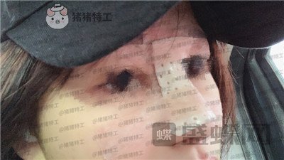 洛阳华美宋俊岭隆鼻案例价格分享,硅胶隆鼻好不好看了就知道!