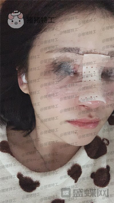 洛阳华美宋俊岭隆鼻案例价格分享,硅胶隆鼻好不好看了就知道!