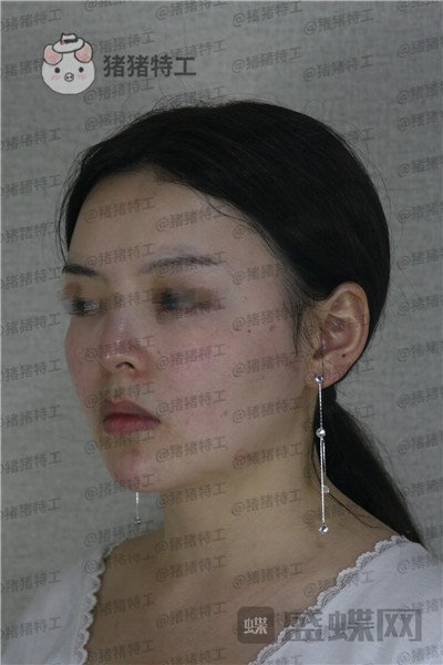 四川友谊张立天颧骨磨骨术案例价格分享,术后十天详介是一种什么体验?
