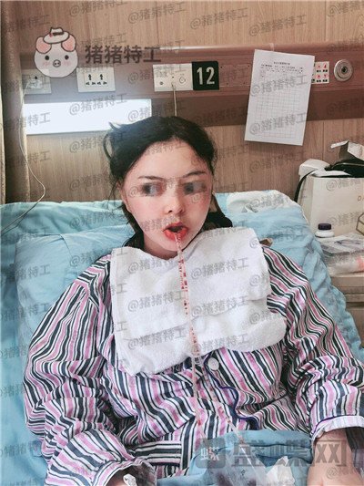 四川友谊张立天颧骨磨骨术案例价格分享,术后十天详介是一种什么体验?