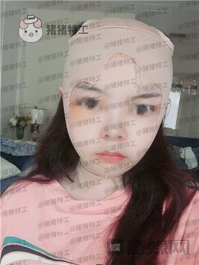 四川友谊张立天颧骨磨骨术案例价格分享,术后十天详介是一种什么体验?
