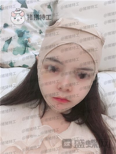 四川友谊张立天颧骨磨骨术案例价格分享,术后十天详介是一种什么体验?